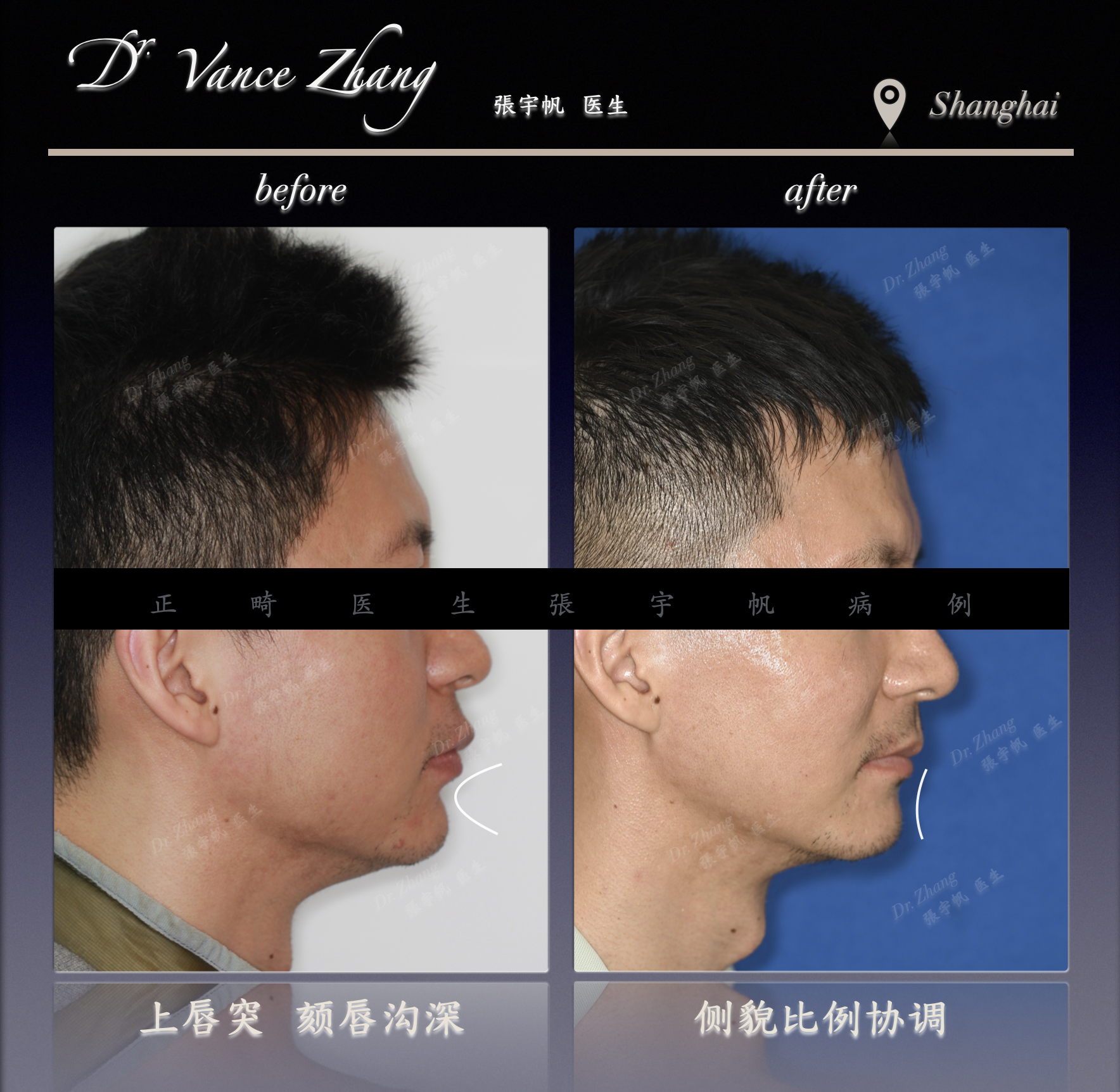 从重度深覆𬌗到健康咬合正式病例贴图5
