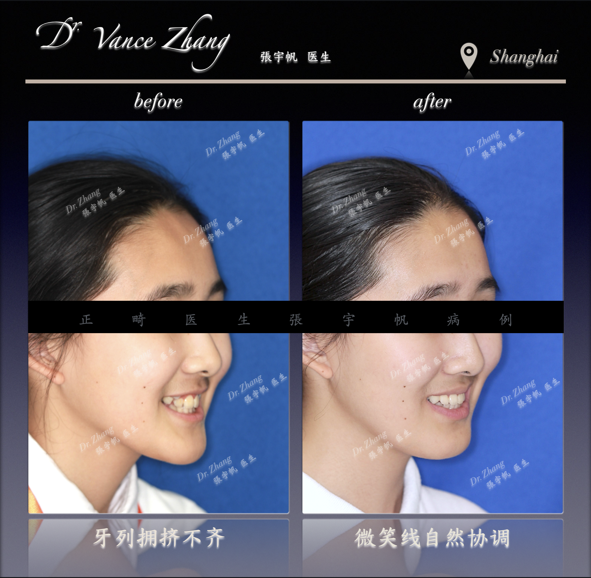 中重度拥挤的非拔牙矫正正式病例贴图4