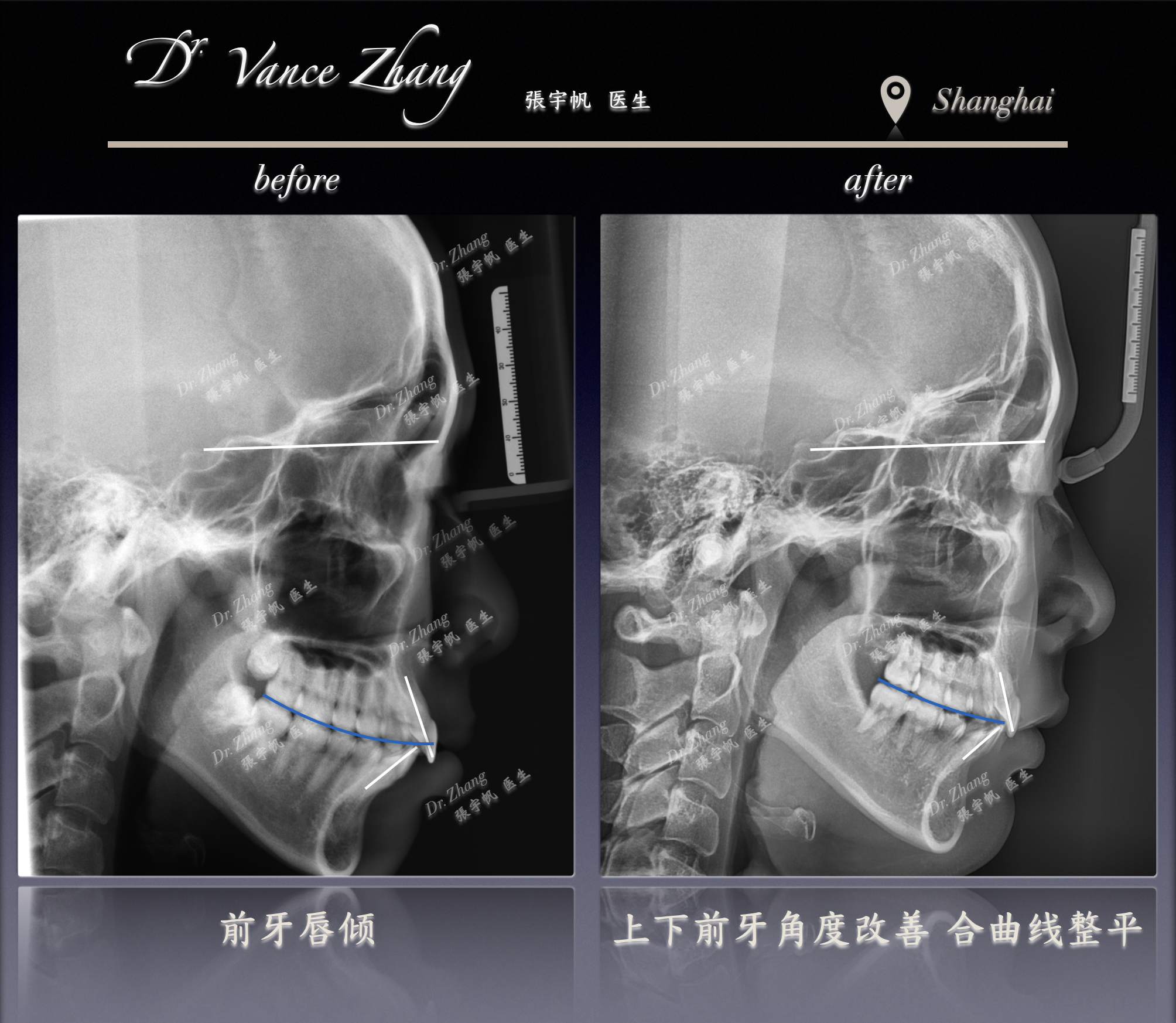 从嘴突到自然微笑正式病例贴图13