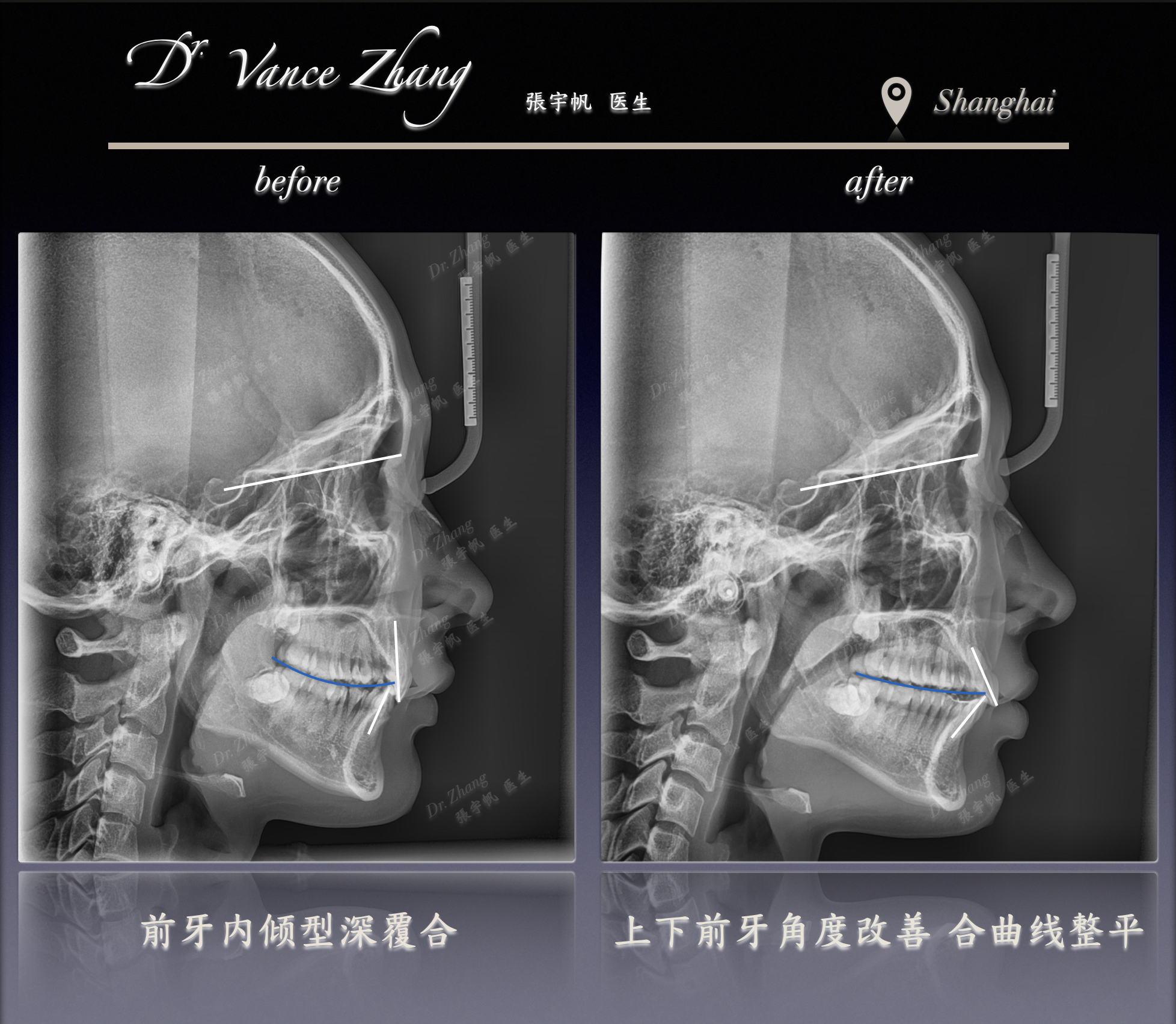 内倾型深覆合不拔牙矫治正式病例贴图15