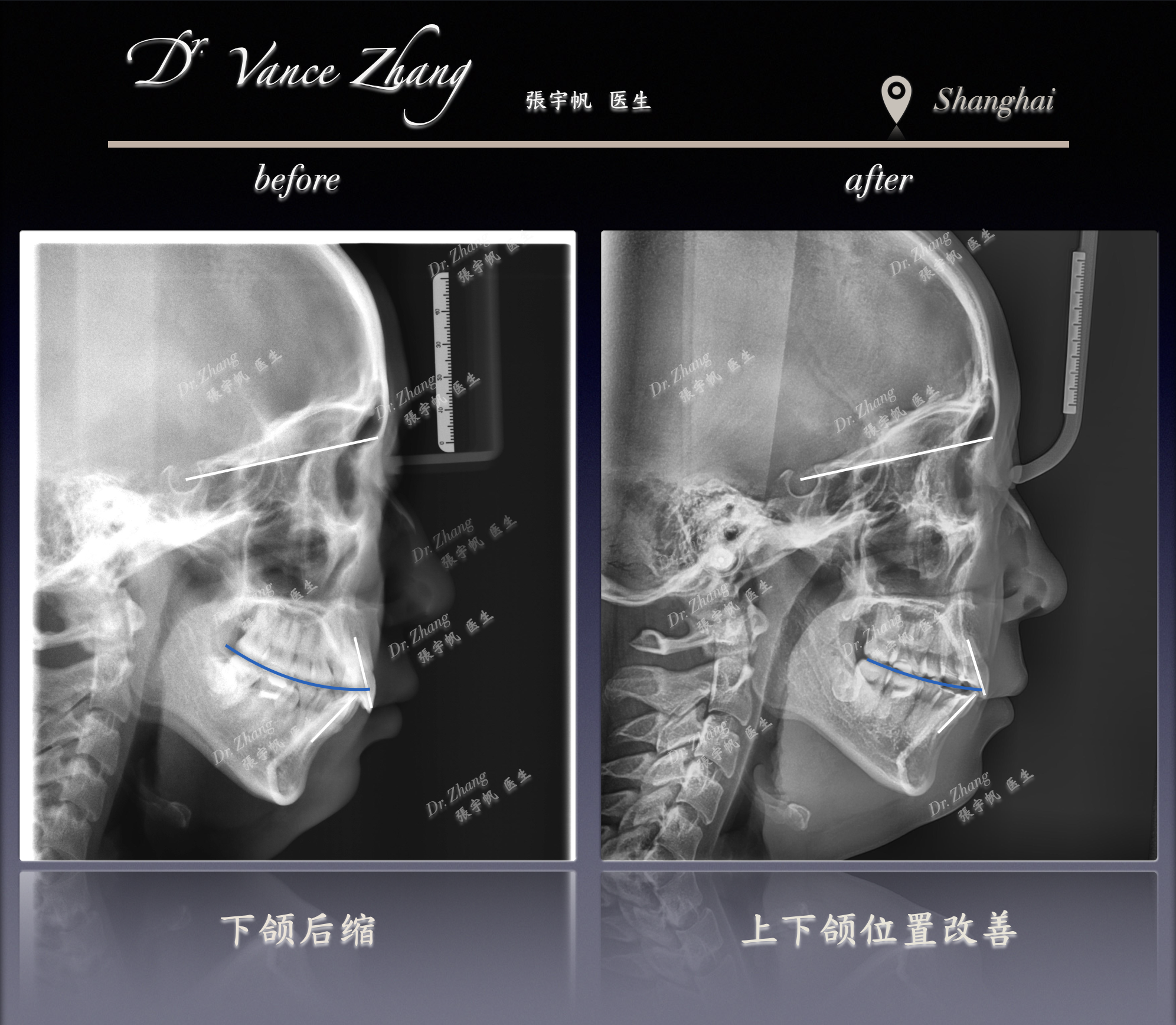 咬合平面偏斜与露龈笑改善正式病例贴图15