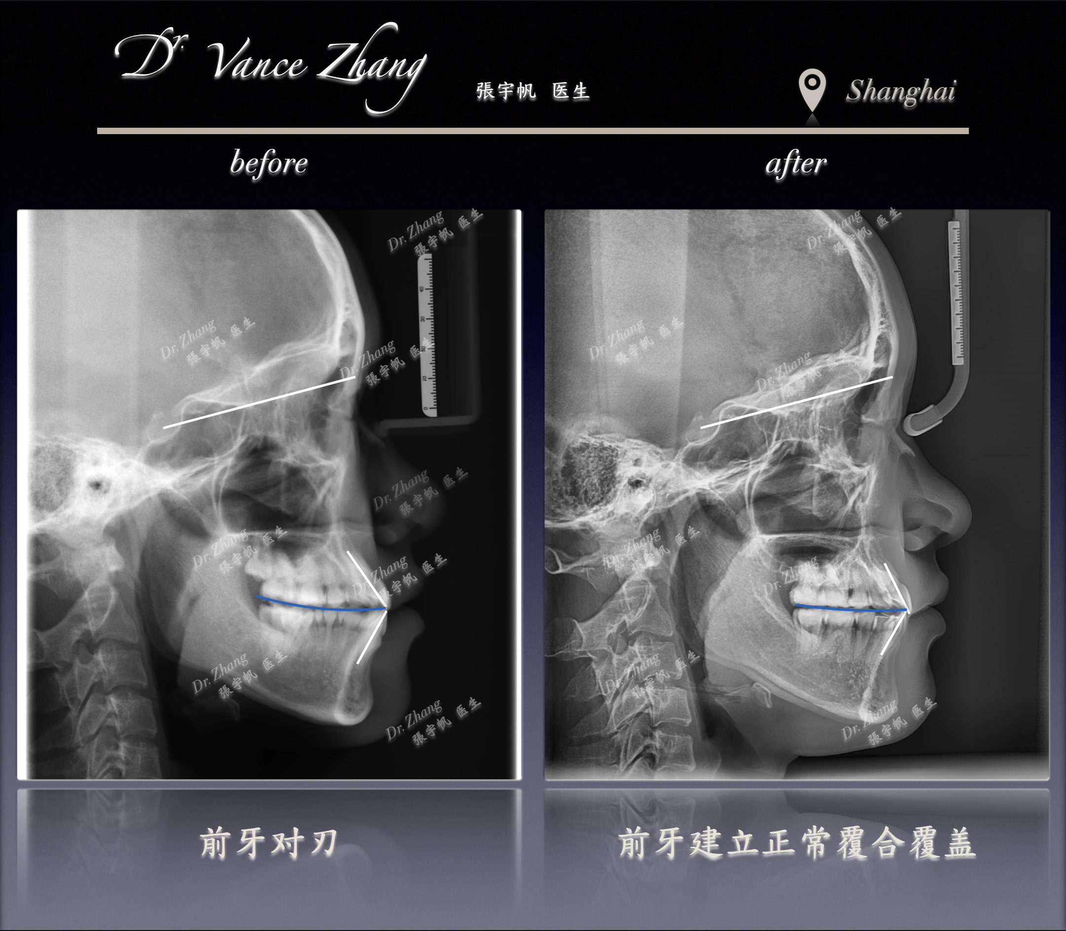 III类双侧后牙严重咬合紊乱正式病例贴图15