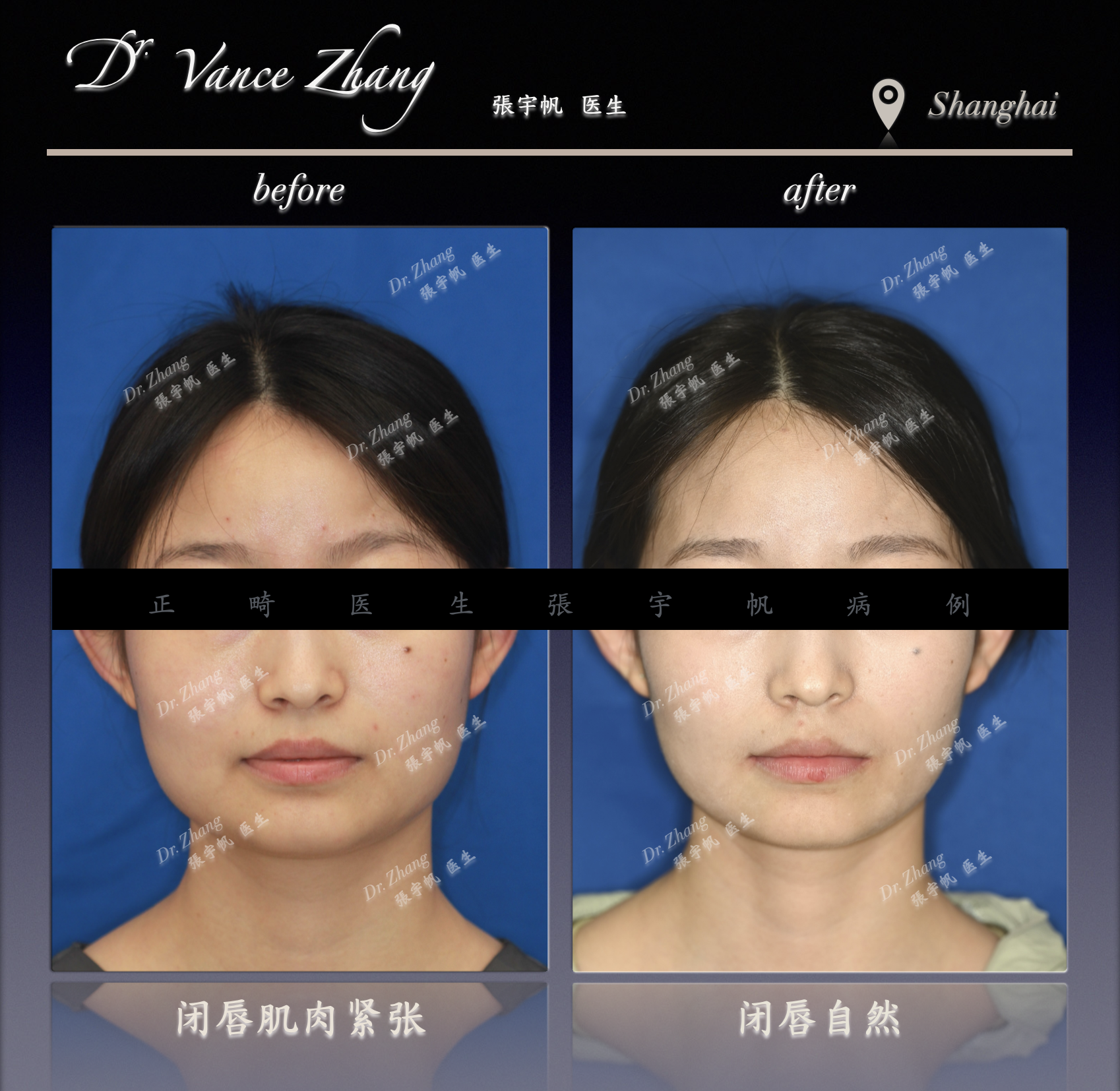 不拔牙之外的另一种选择正式病例贴图2