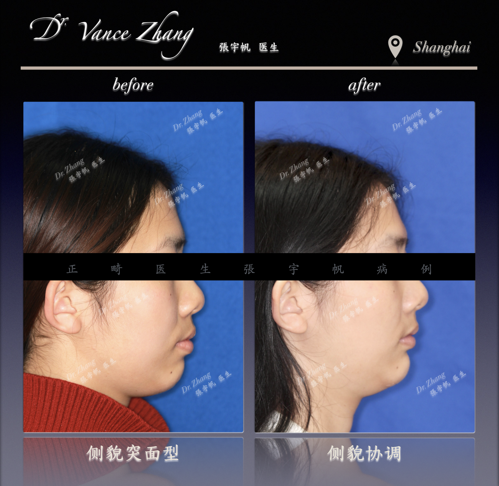 从嘴突到自然微笑正式病例贴图5