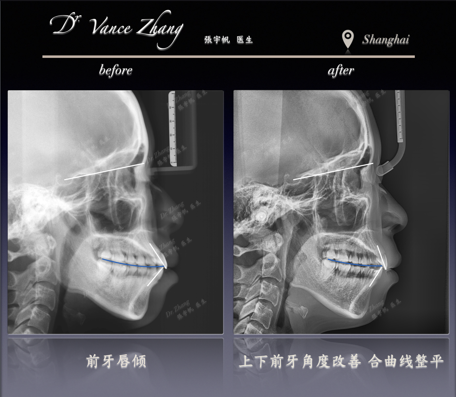 隐形矫治关闭牙列间隙正式病例贴图15