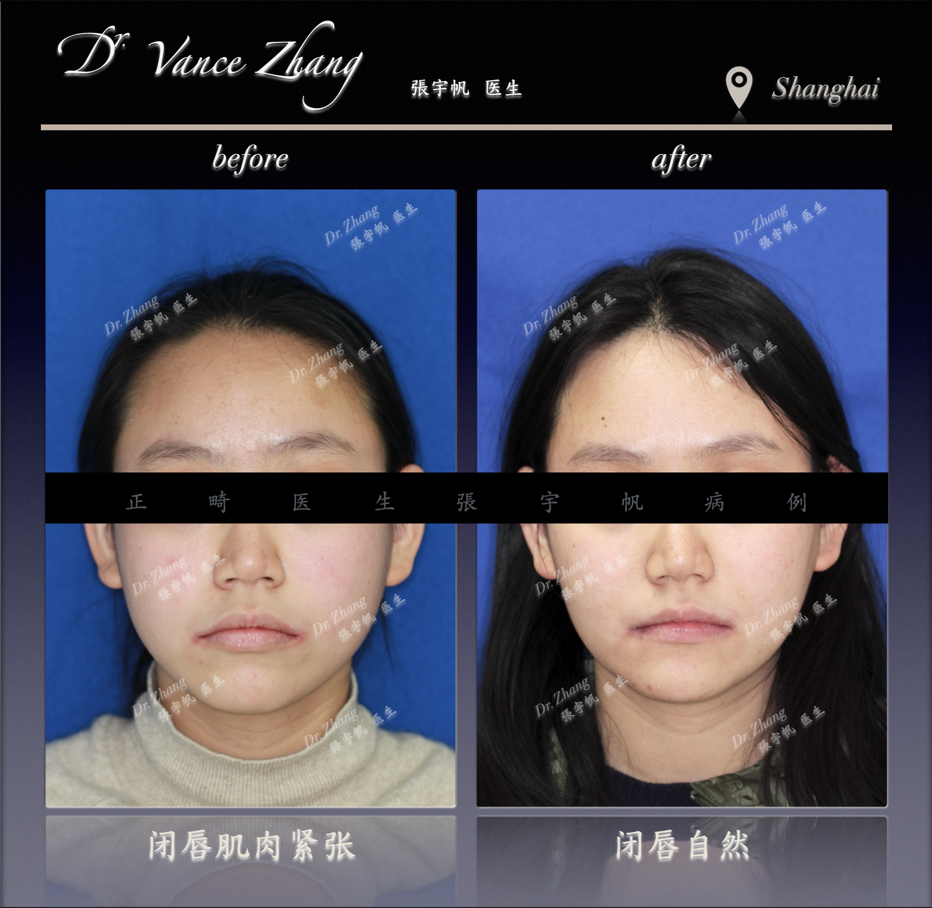 青少年拔牙矫正案例正式病例贴图2