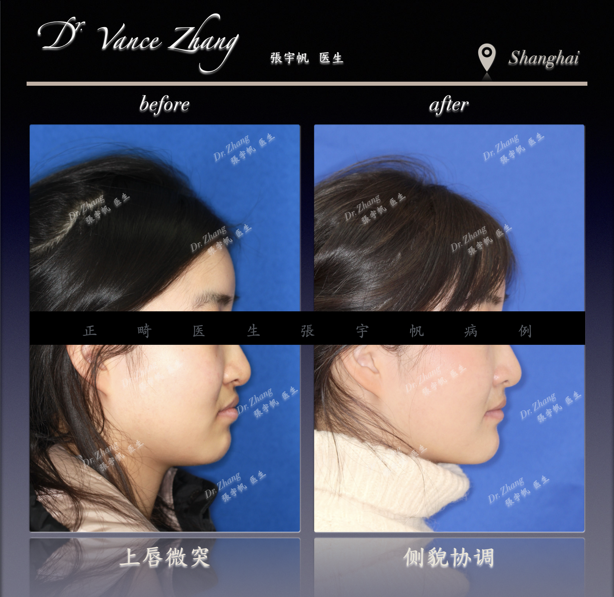 拔牙与不拔牙之间正式病例贴图5
