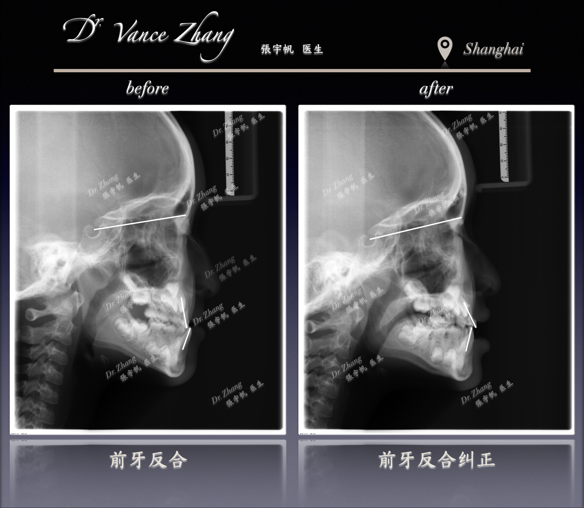 乳牙期前牙反𬌗的早期干预正式病例贴图15