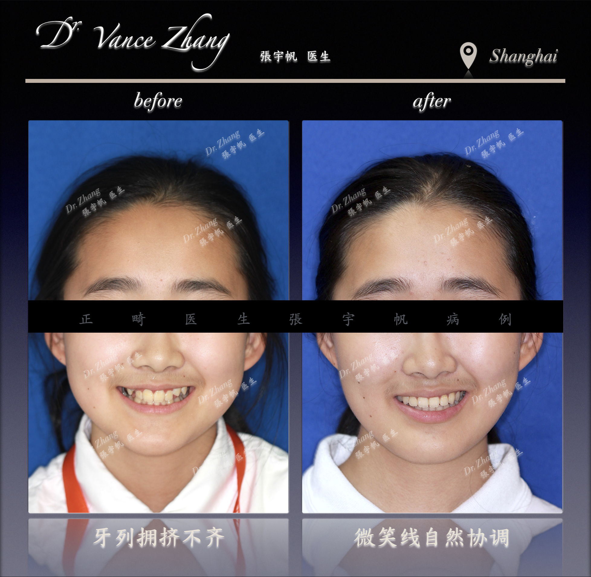 中重度拥挤的非拔牙矫正正式病例贴图3