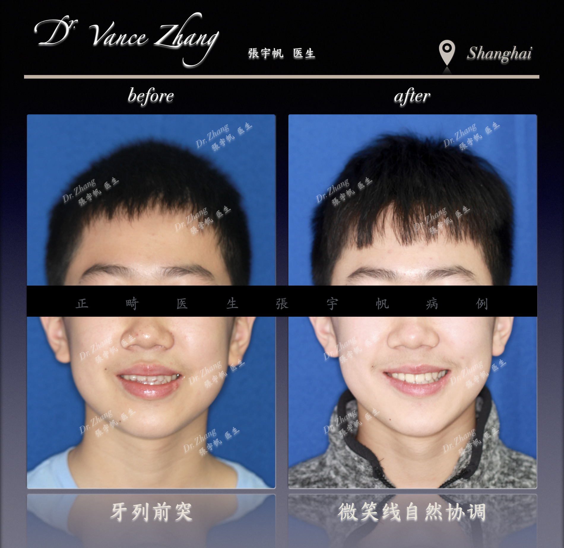 青少年Ⅲ类错𬌗矫治正式病例贴图3