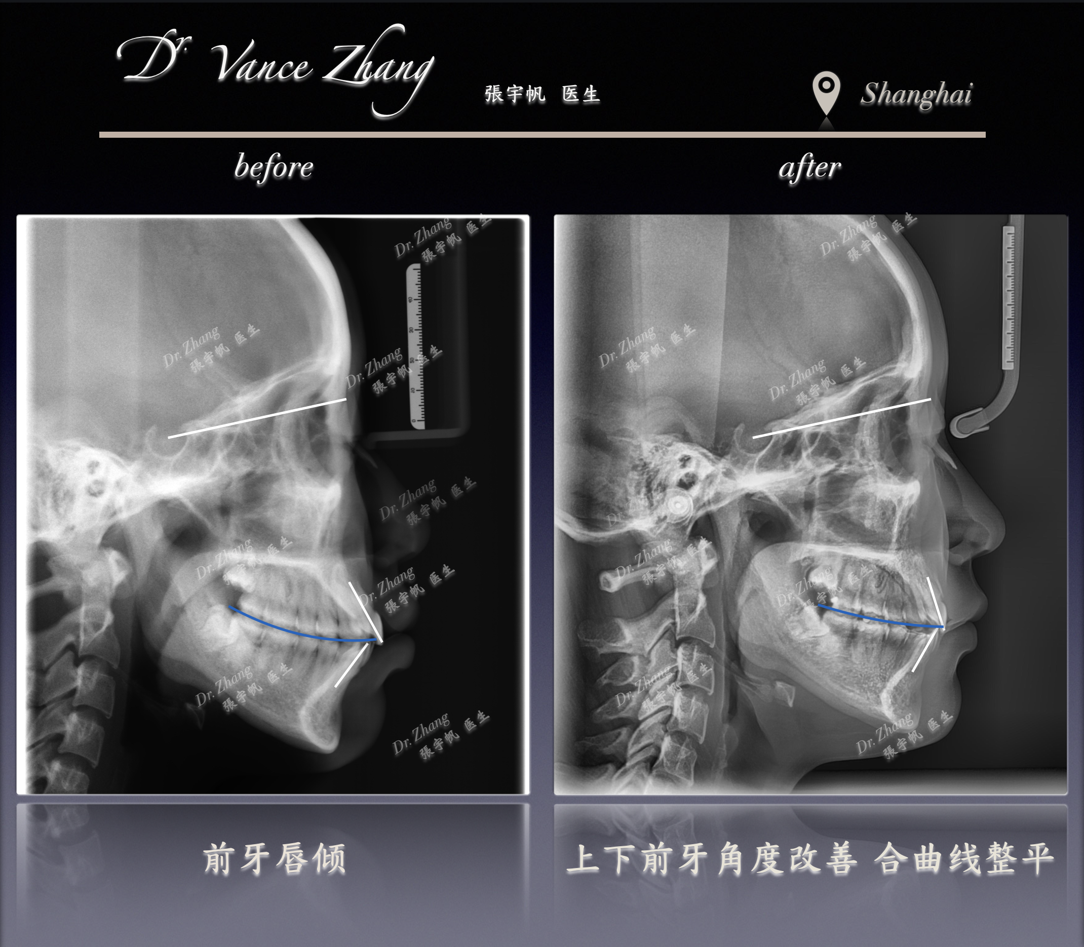 青少年拔牙矫正案例正式病例贴图15