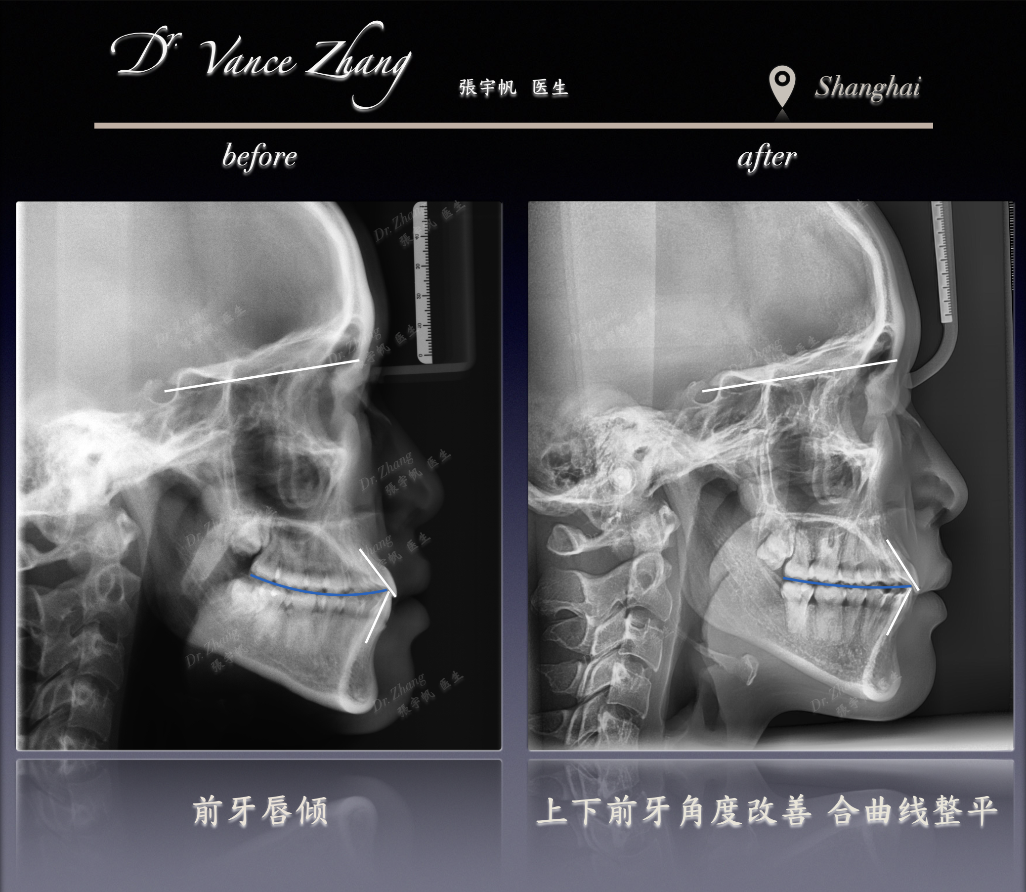 偏颌与反𬌗的改善正式病例贴图15