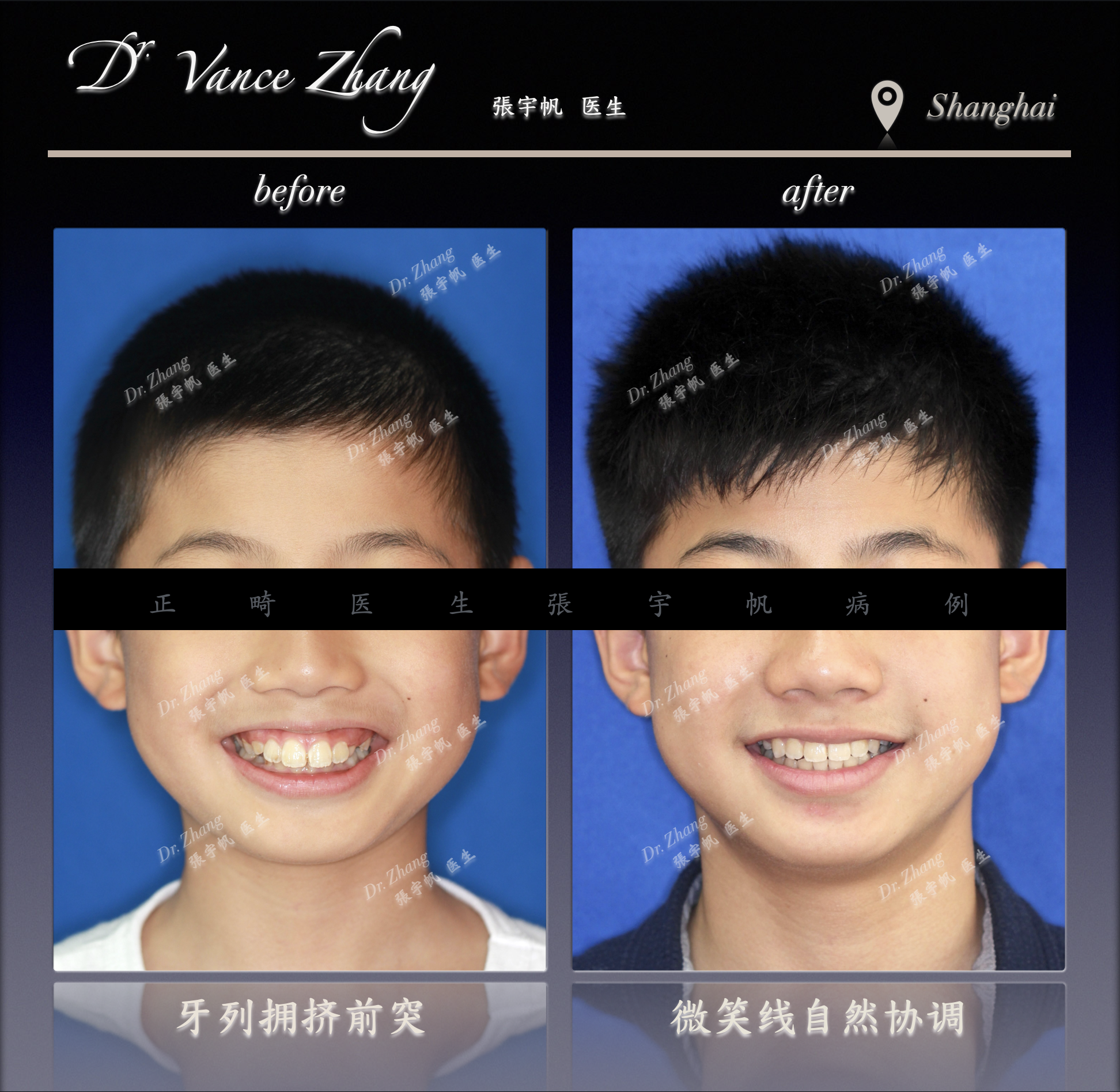颜面发育管理的意义正式病例贴图3