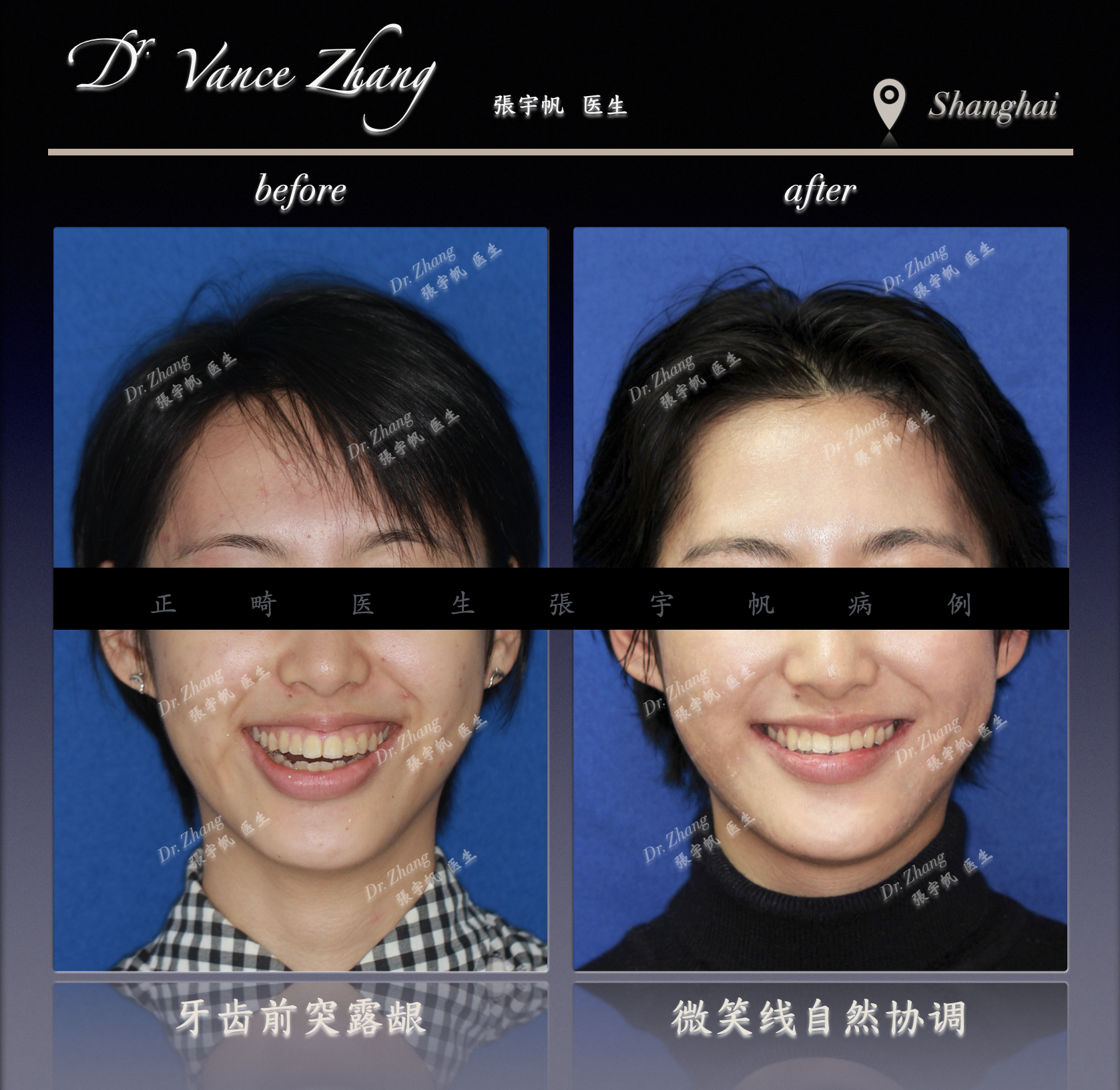 牙齿前突改善：美观与安全的平衡正式病例贴图3