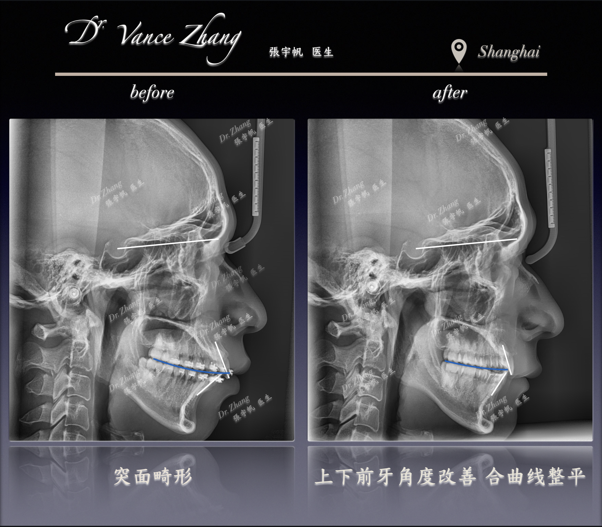 骨性嘴突二次矫正正式病例贴图16