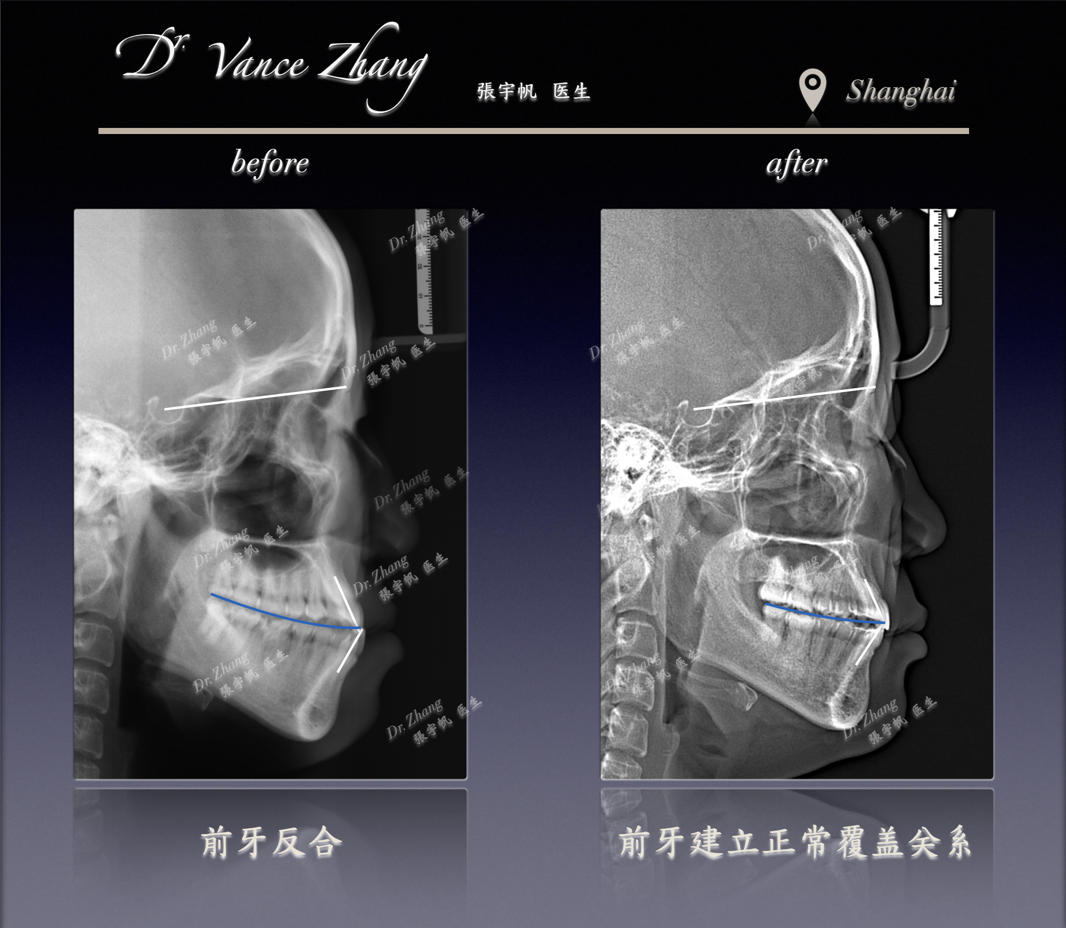 III类拔除下颌6号牙后的智齿前移正式病例贴图15