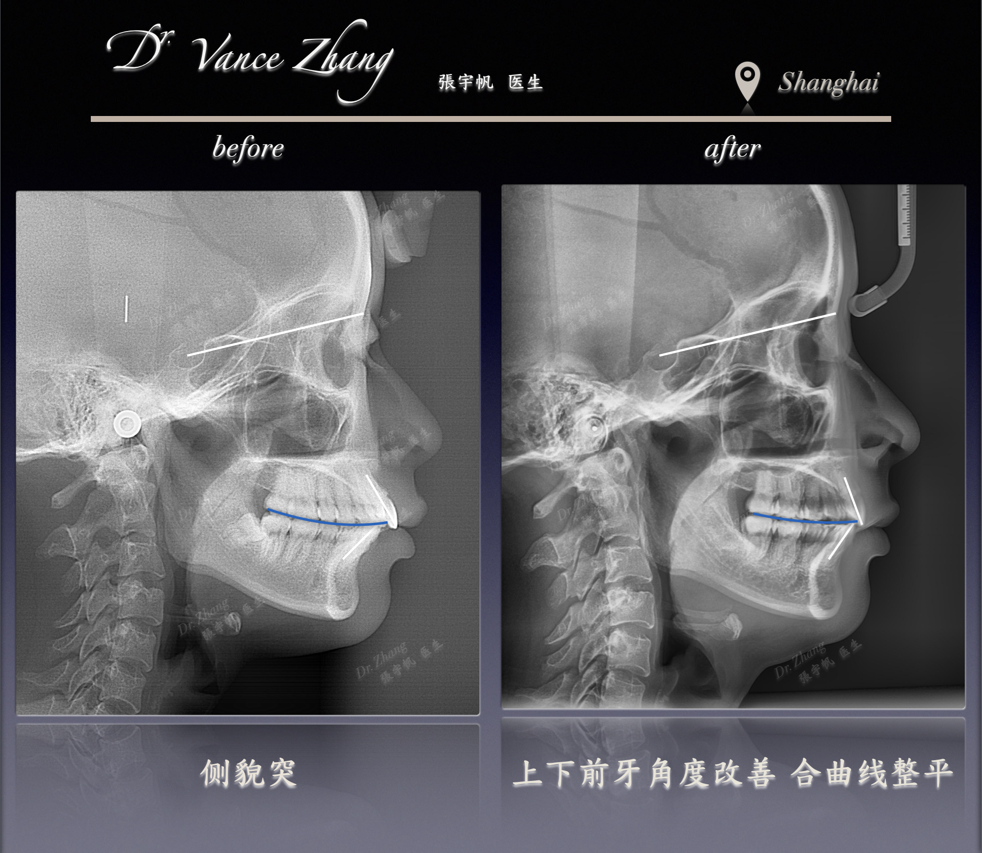 骨性Ⅱ类嘴突的拔牙内收正式病例贴图13