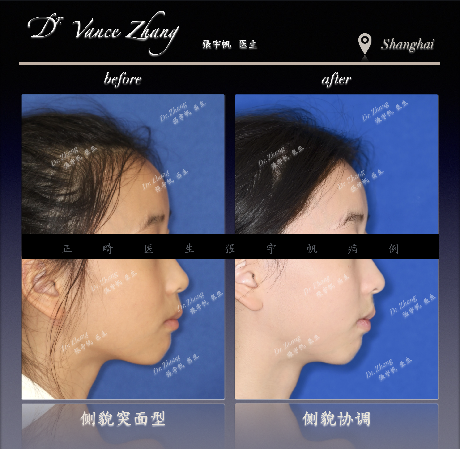 生长发育期的矫正机会正式病例贴图5