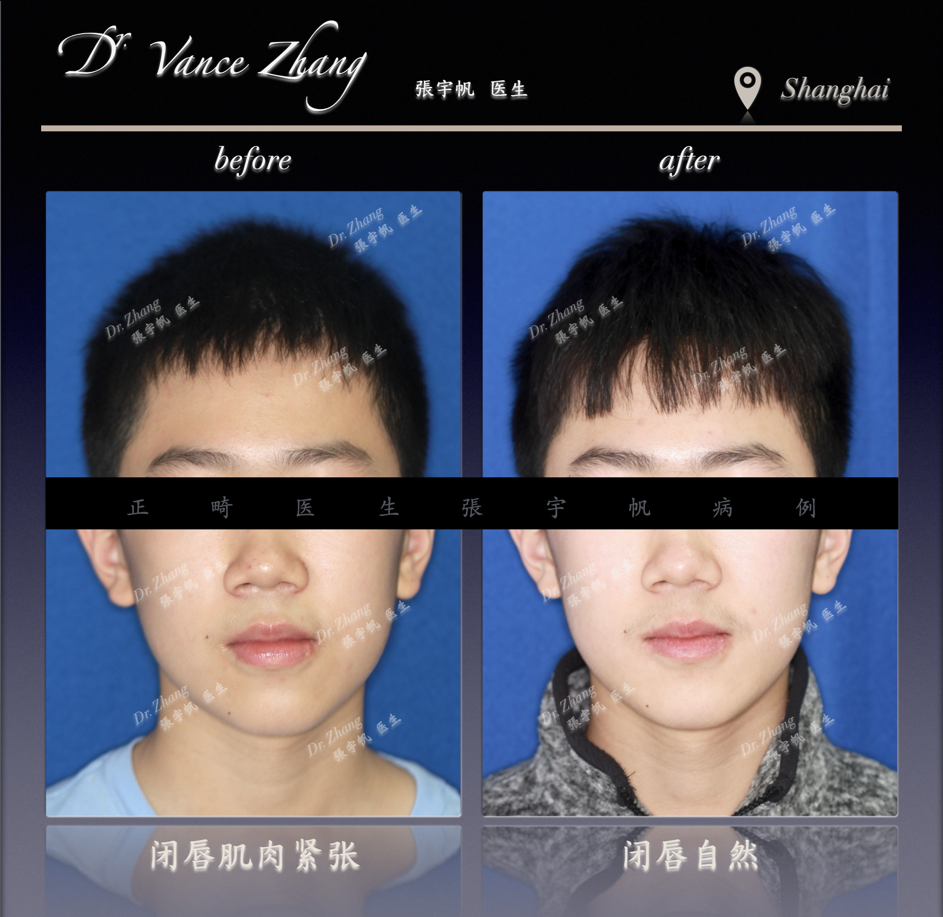 青少年Ⅲ类错𬌗矫治正式病例贴图2