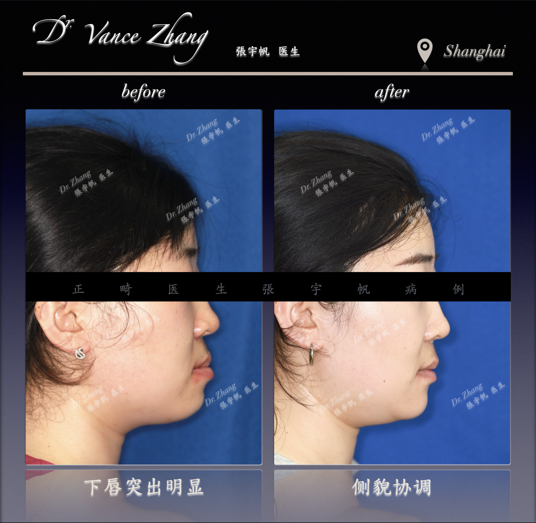 III类拔除下颌6号牙后的智齿前移正式病例贴图5