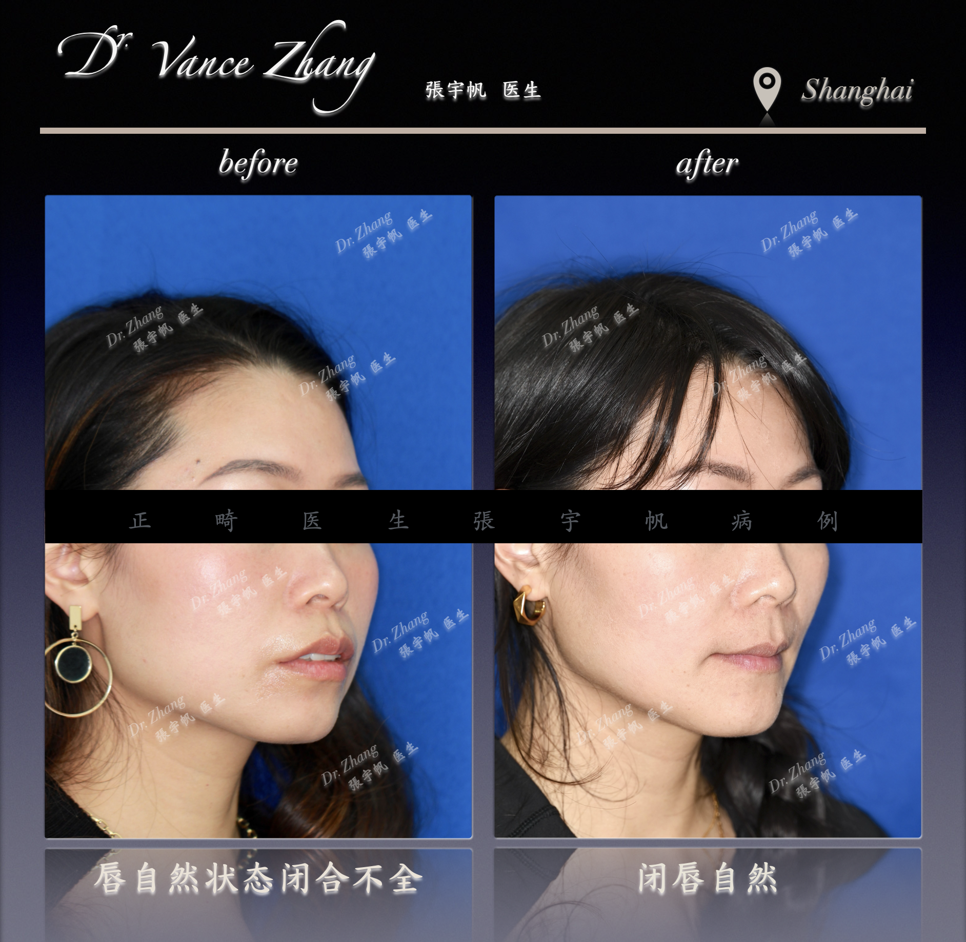 成人女性骨型双颌前突矫正正式病例贴图4