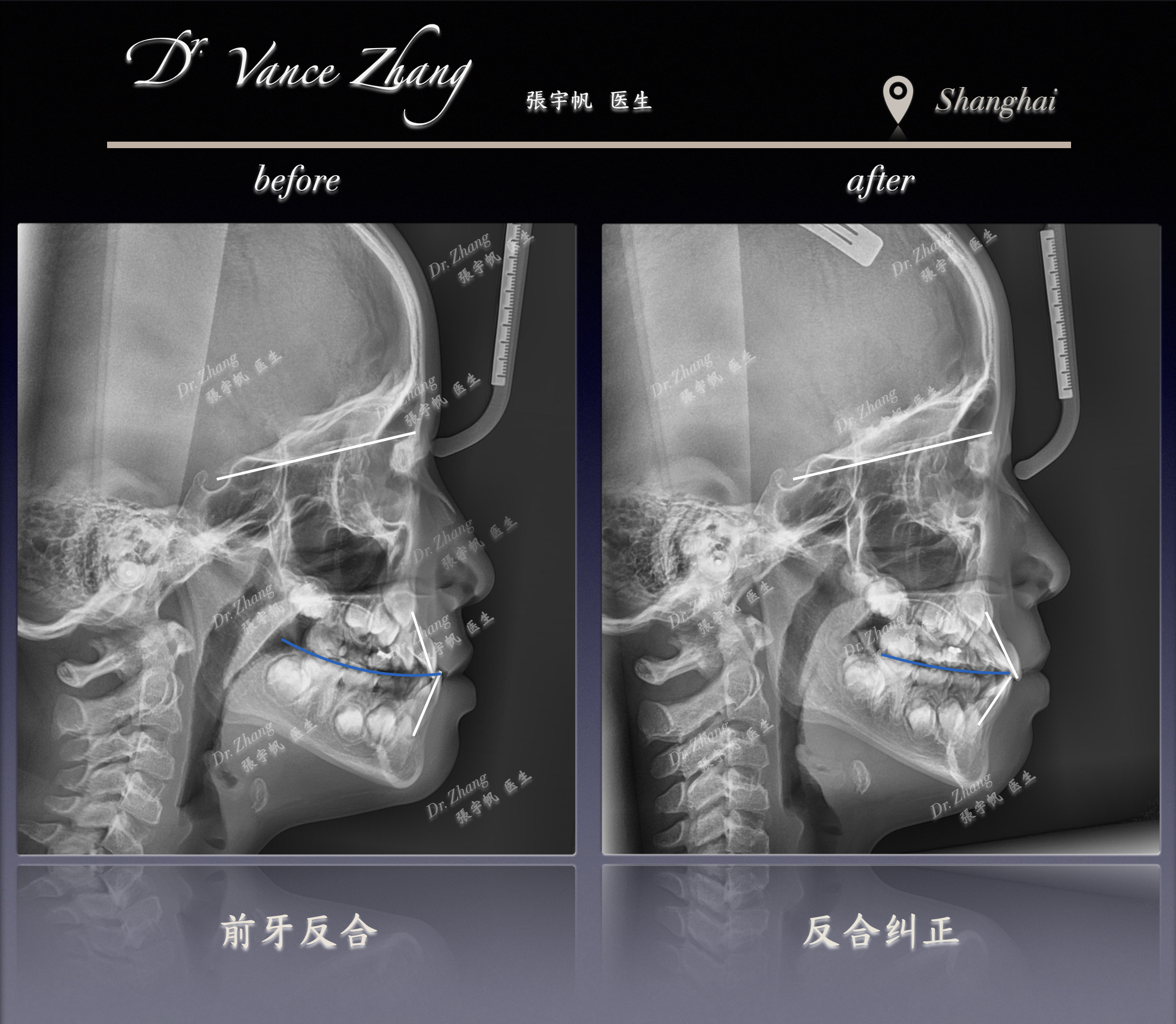 让牙齿回到正确的生长轨道正式病例贴图14