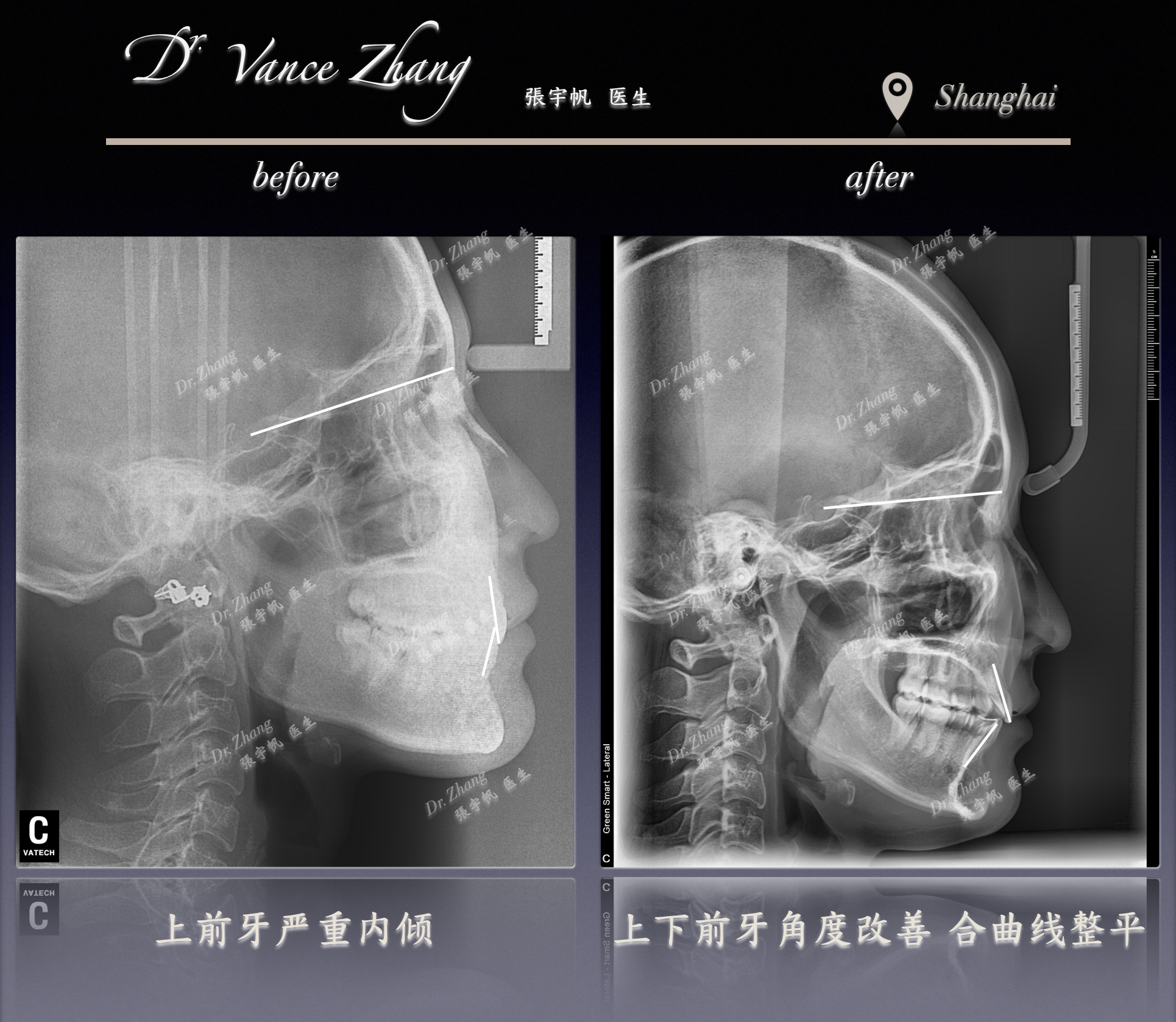 从露龈笑到自然微笑正式病例贴图12