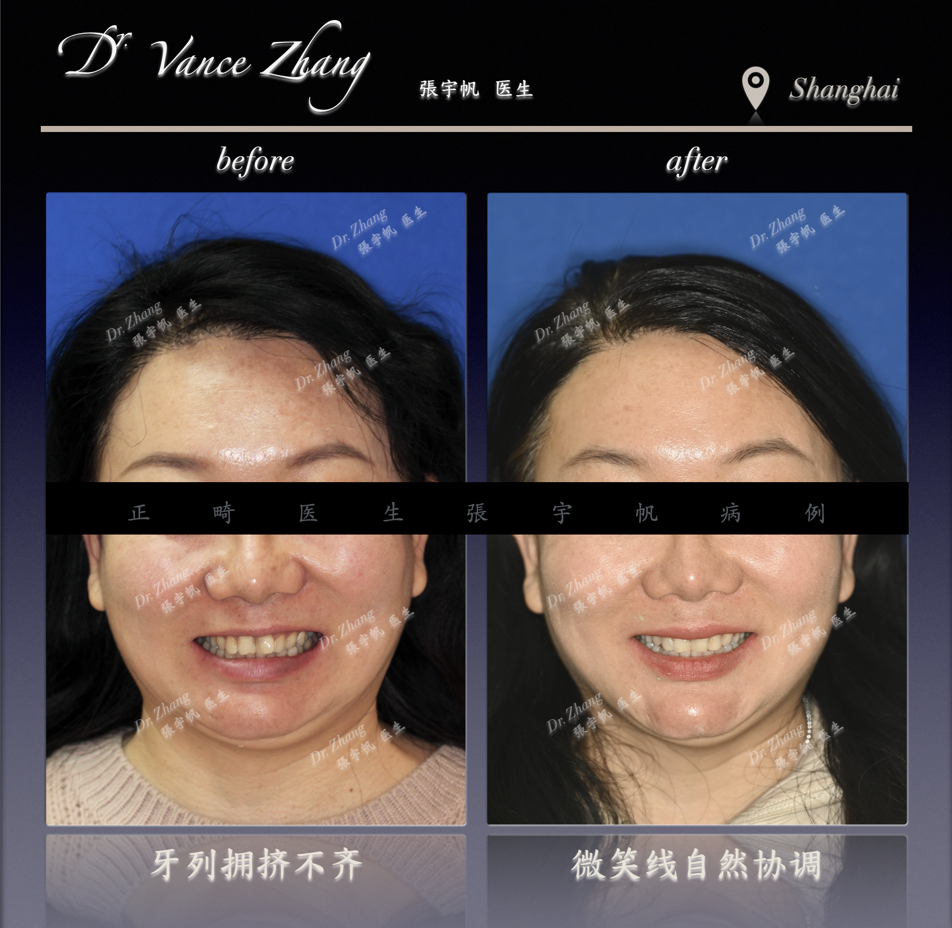 轻度拥挤的非拔牙方案正式病例贴图3