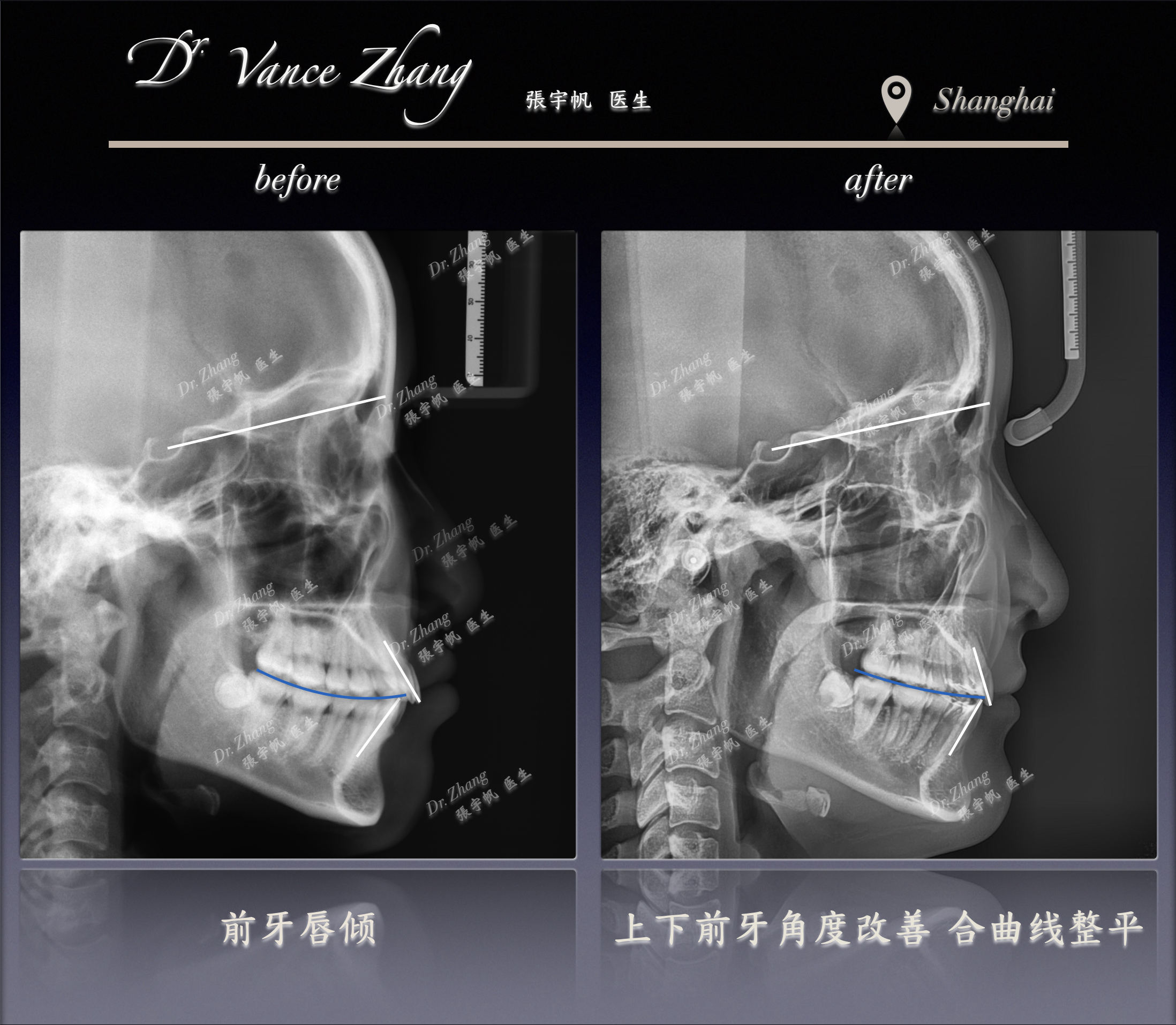 拔牙与不拔牙之间正式病例贴图15