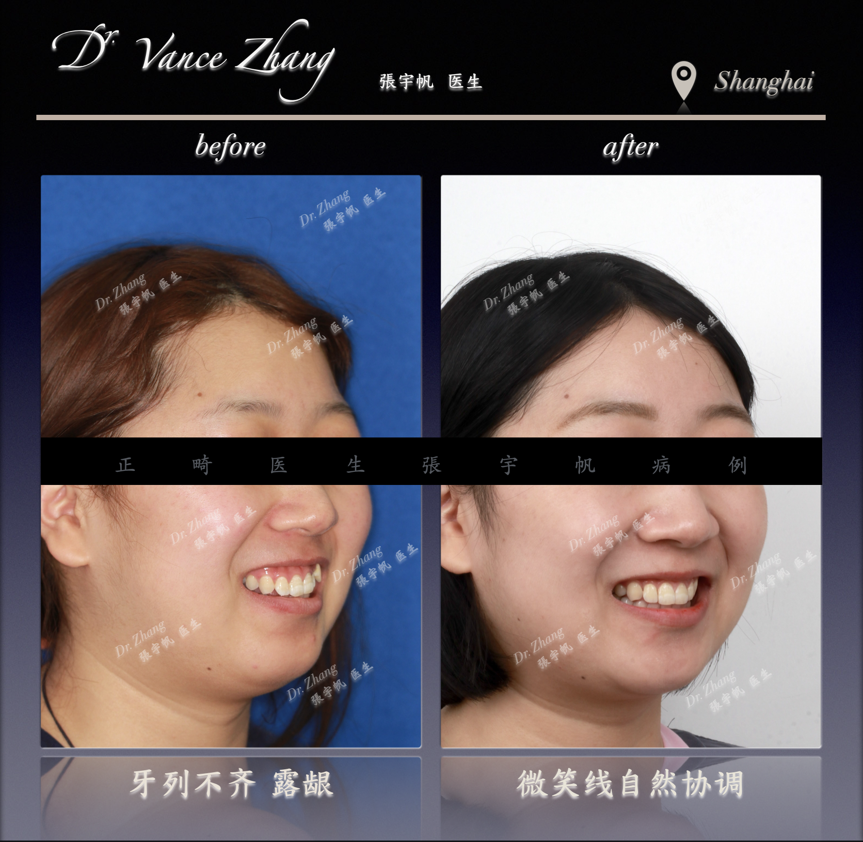 咬合平面偏斜与露龈笑改善正式病例贴图4
