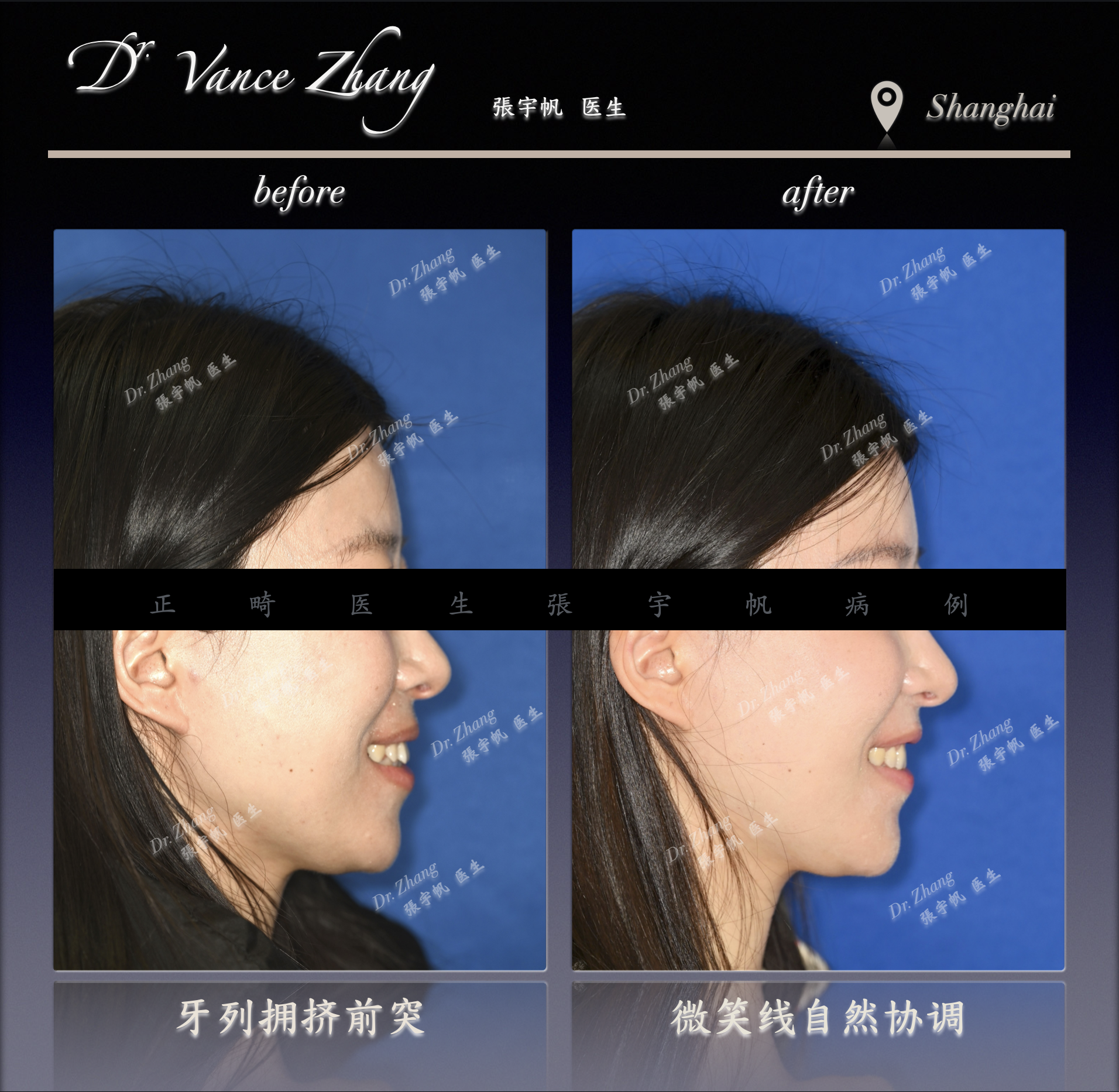远移磨牙的临床意义正式病例贴图6