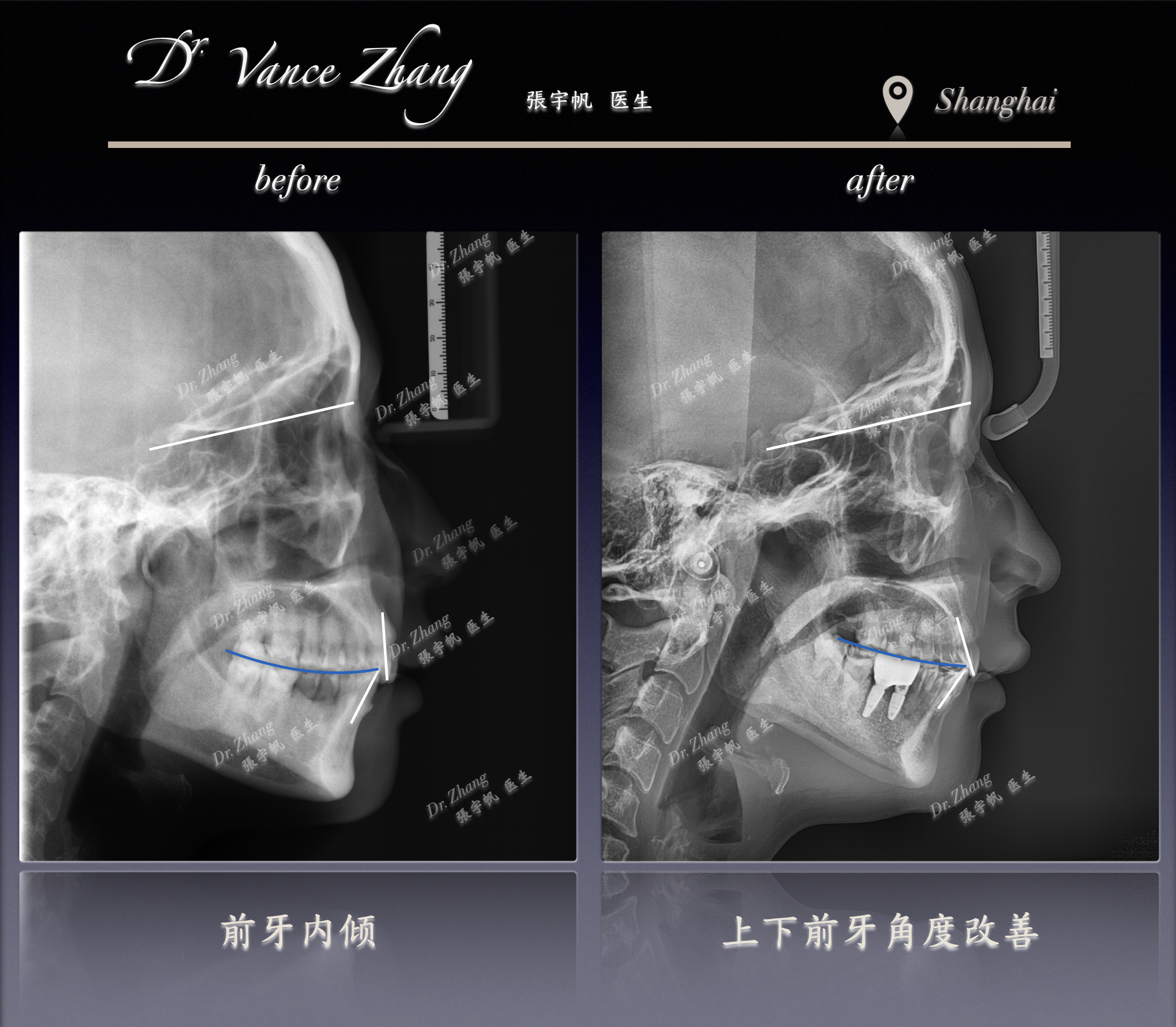 从深覆𬌗到协调咬合正式病例贴图15