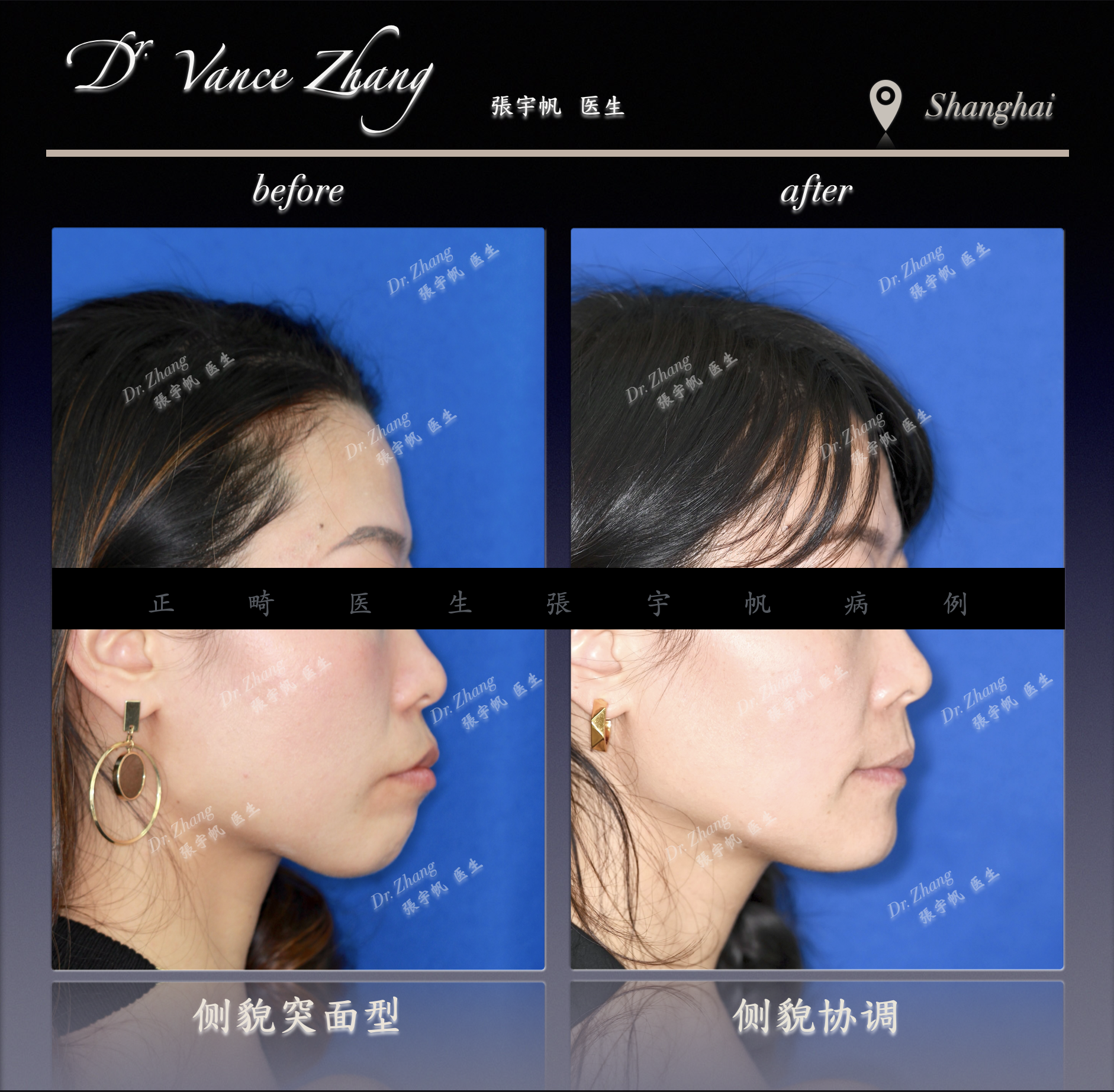 成人女性骨型双颌前突矫正正式病例贴图5