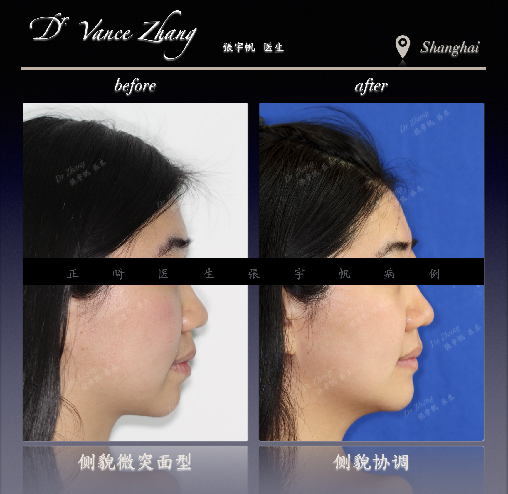 牙列拥挤的拔牙矫正与咬合改善正式病例贴图5