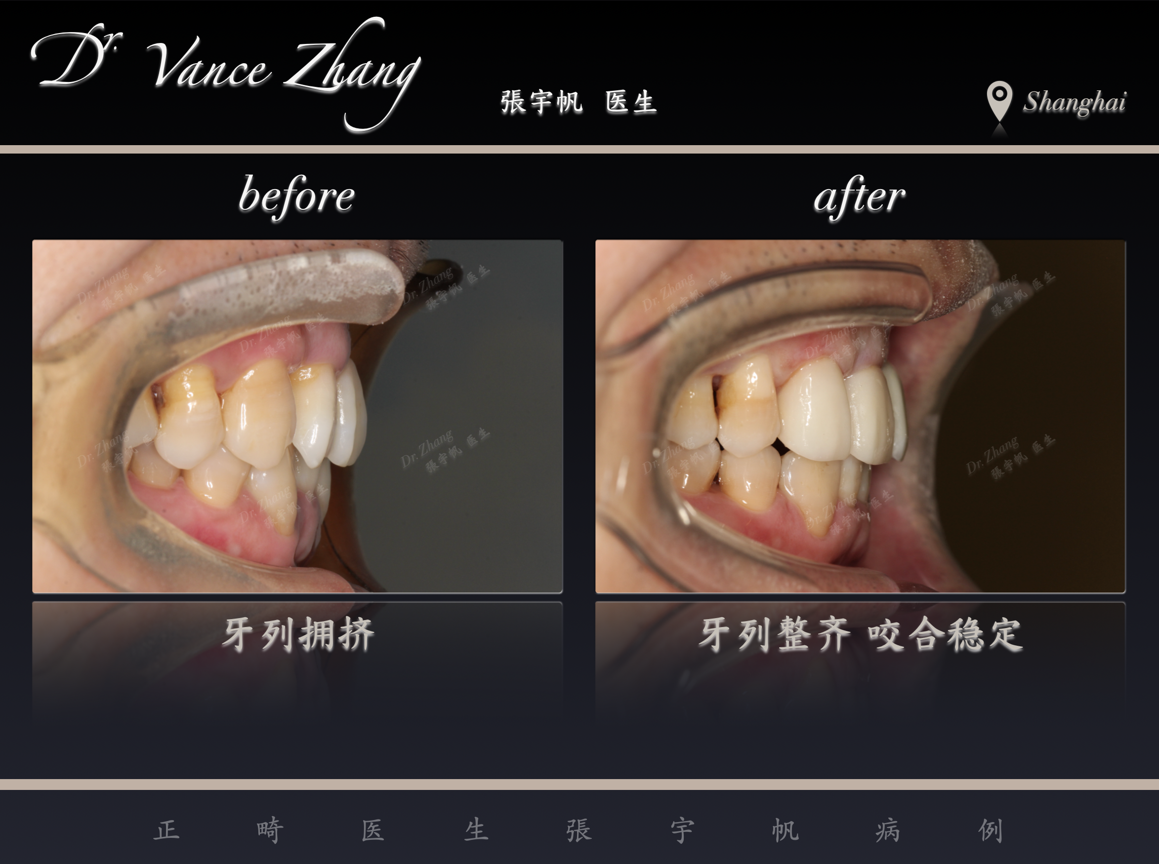 拔除下7后近移智齿替代正式病例贴图10