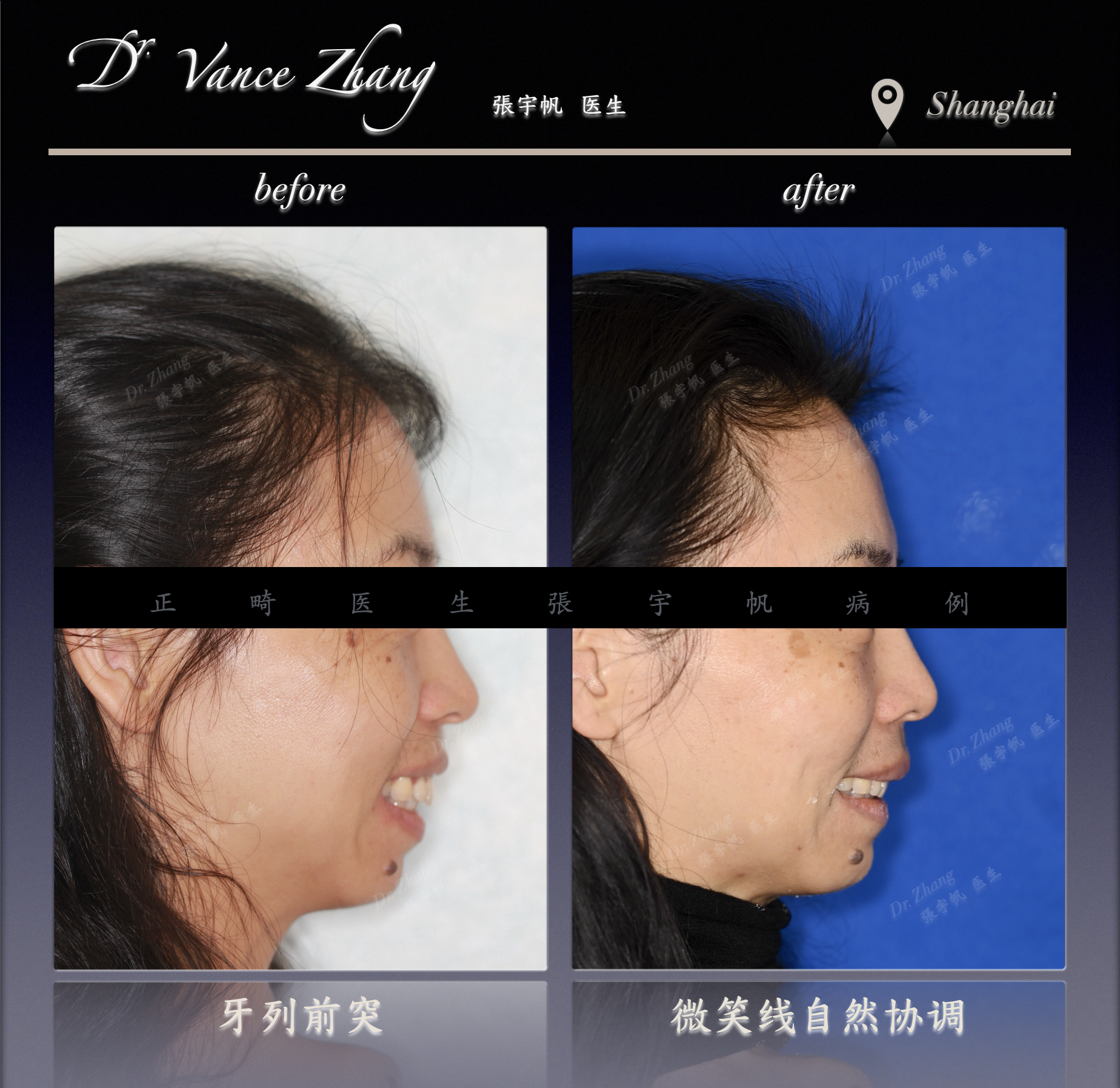 成人牙缝与黑三角的隐形矫正正式病例贴图6