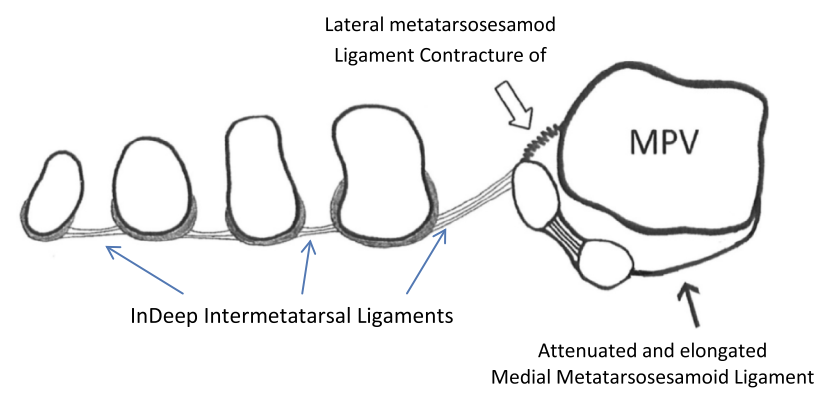 【手术技巧】拇外翻非截骨韧带联合术（Syndesmosis