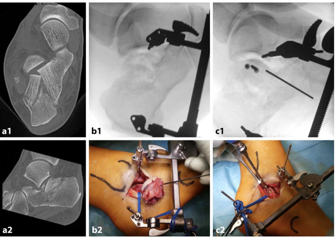 【手术技巧】跟骨骨折的规范操作技术（德国经验）