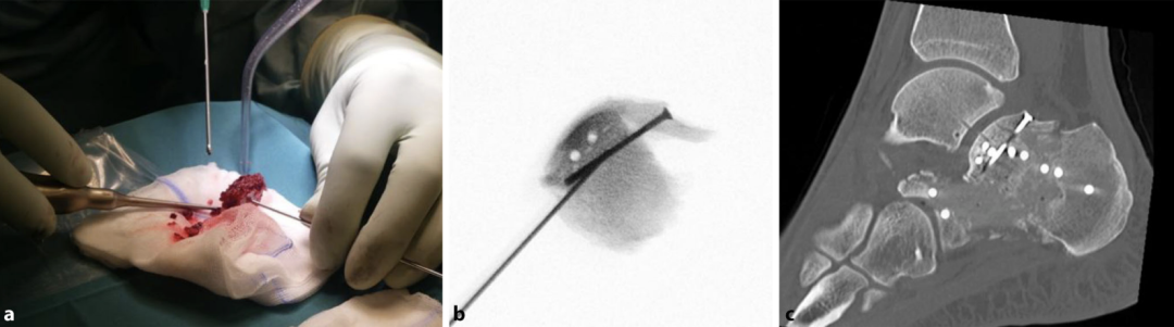 【手术技巧】跟骨骨折的规范操作技术（德国经验）