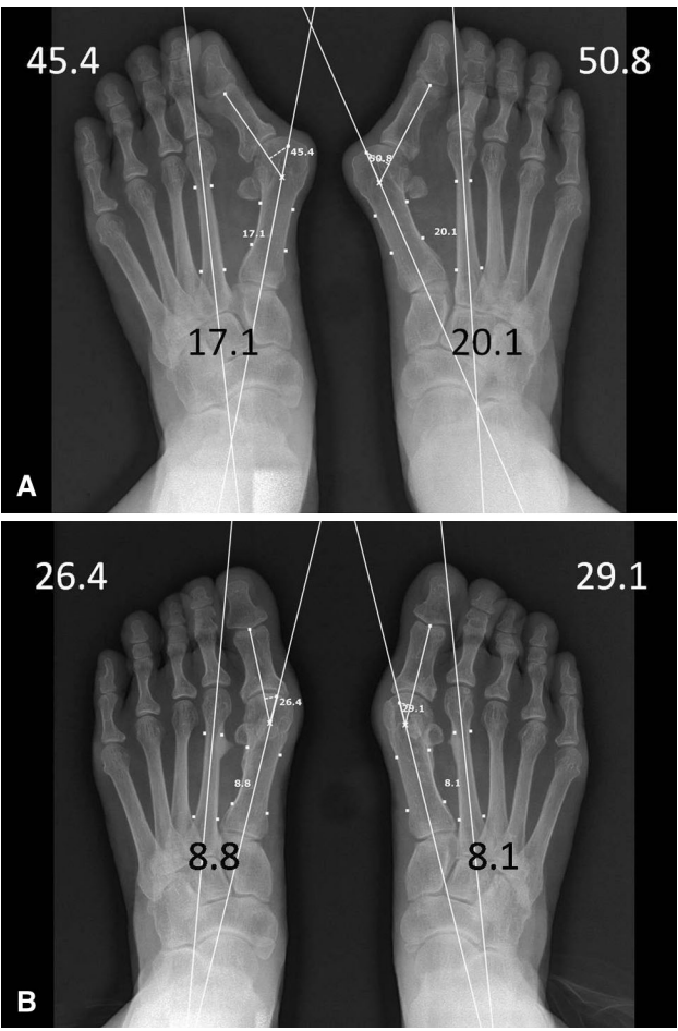 【手术技巧】拇外翻非截骨韧带联合术（Syndesmosis