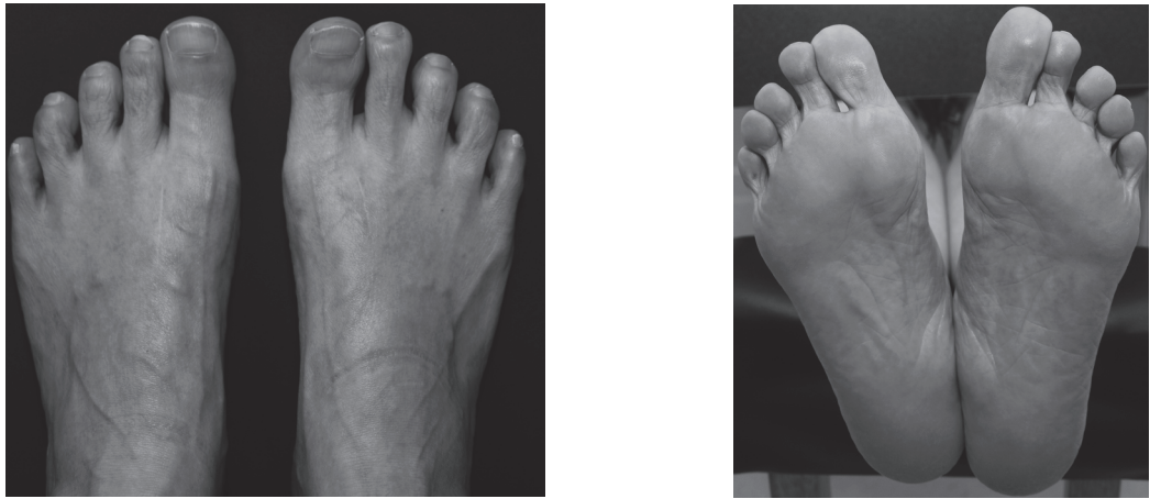 【手术技巧】拇外翻非截骨韧带联合术（Syndesmosis