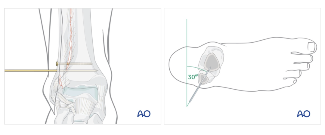 【手术技巧】下胫腓联合螺钉冠状面打歪了要紧不？