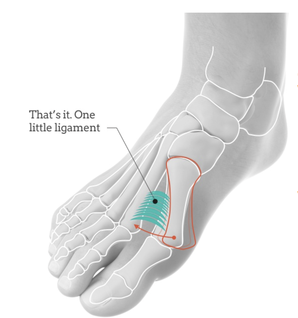 【手术技巧】拇外翻非截骨韧带联合术（Syndesmosis