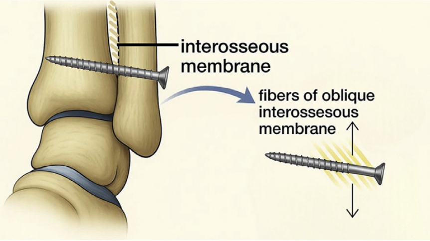 【手术技巧】下胫腓联合螺钉冠状面打歪了要紧不？