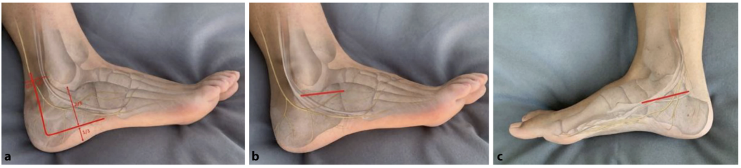 【手术技巧】跟骨骨折的规范操作技术（德国经验）