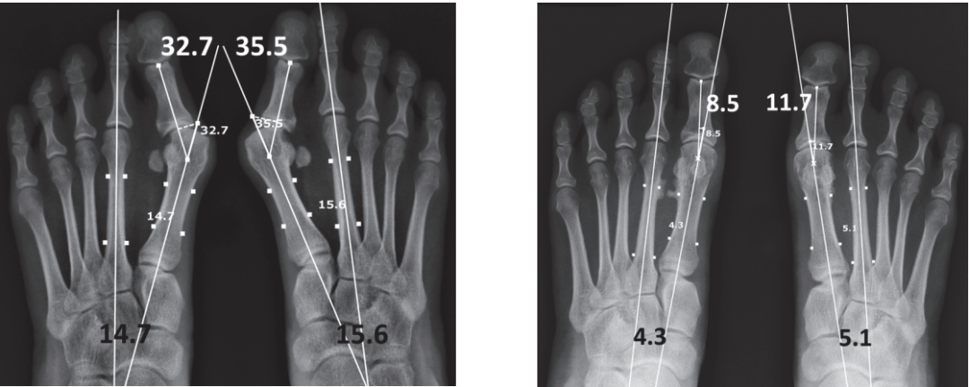 【手术技巧】拇外翻非截骨韧带联合术（Syndesmosis