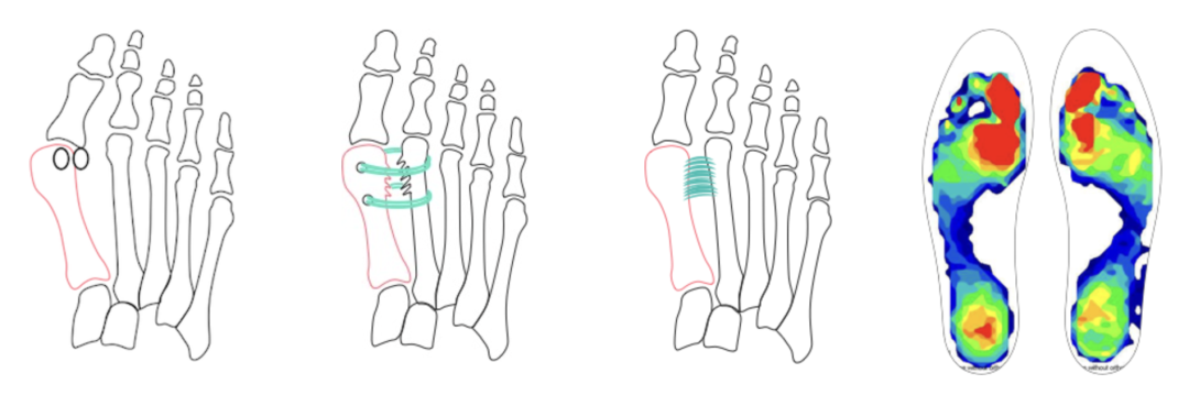 【手术技巧】拇外翻非截骨韧带联合术（Syndesmosis