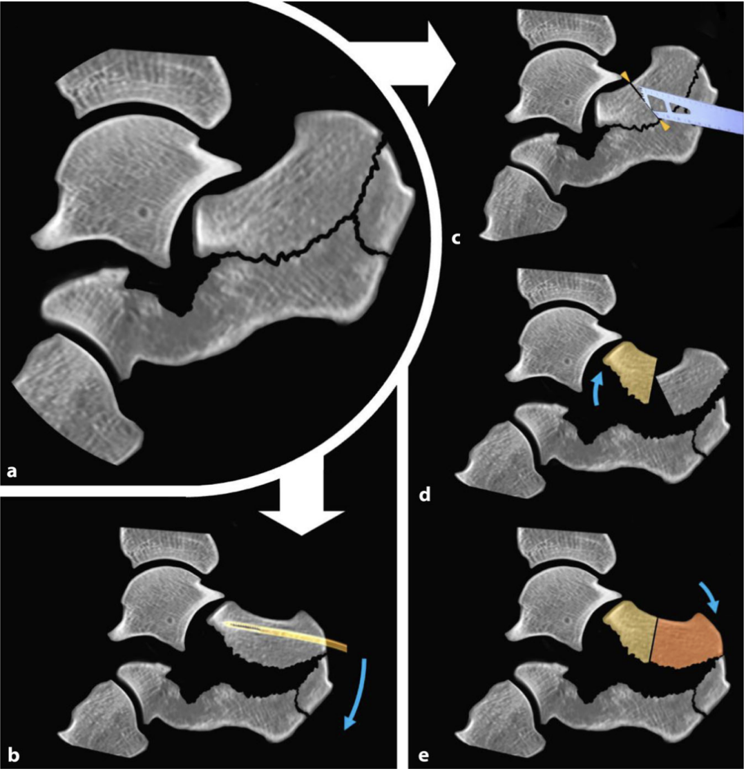 【手术技巧】跟骨骨折的规范操作技术（德国经验）