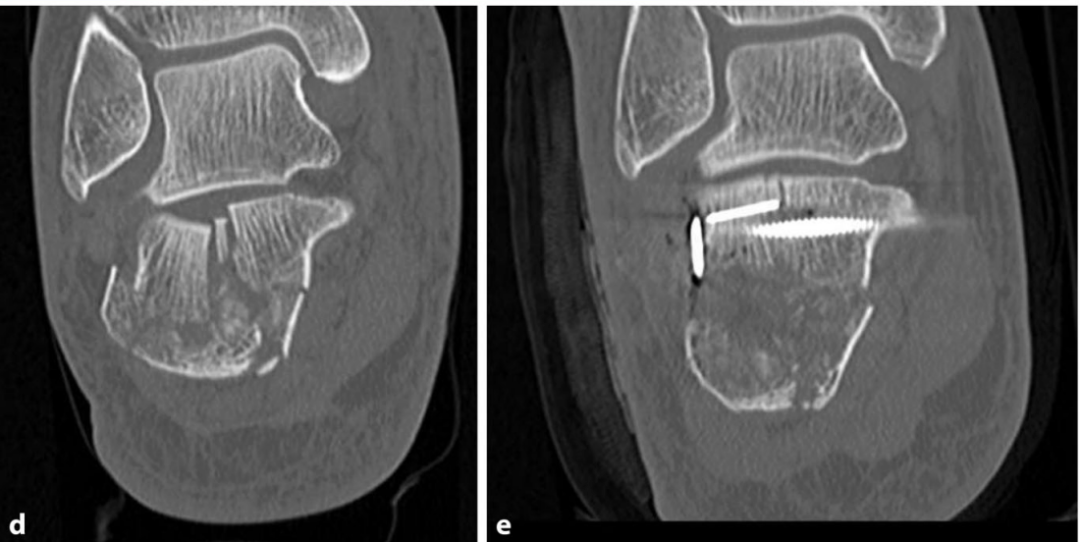 【手术技巧】跟骨骨折的规范操作技术（德国经验）