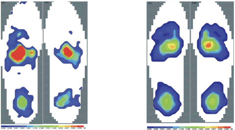 【手术技巧】拇外翻非截骨韧带联合术（Syndesmosis